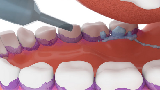 Pneumonia associada à ventilação mecânica: Desenvolvimento e prevenção